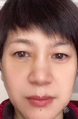 去眼袋手术
