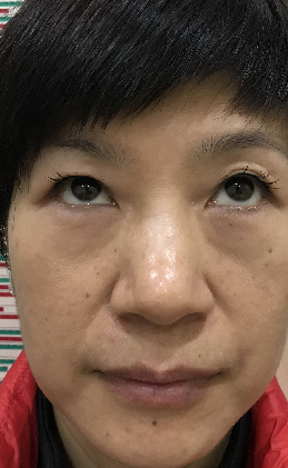去眼袋手术