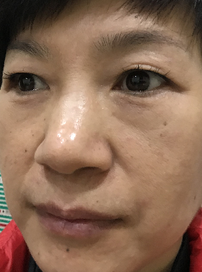 去眼袋手术
