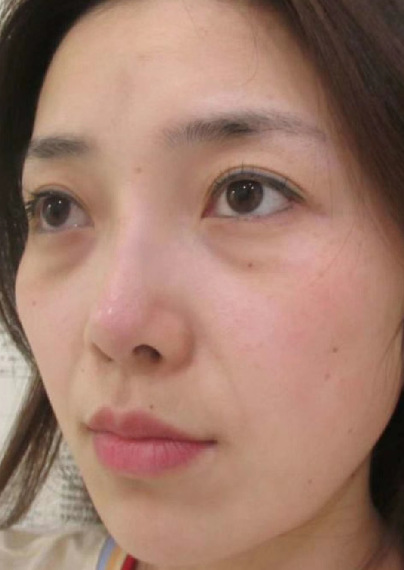 去眼袋手术