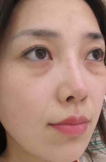 去眼袋手术