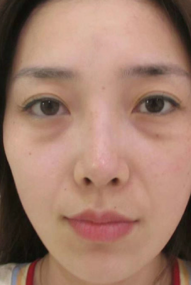 去眼袋手术