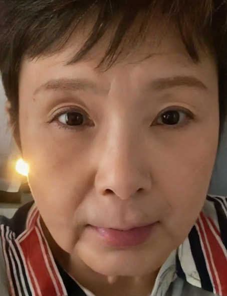 去眼袋手术