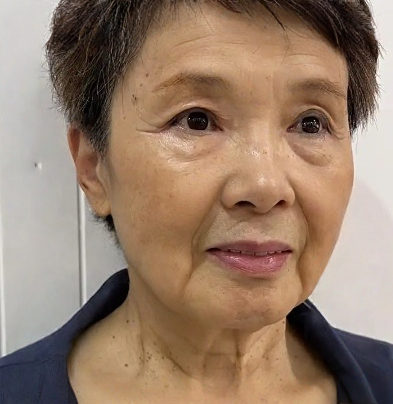 去眼袋手术