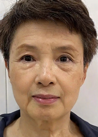 去眼袋手术