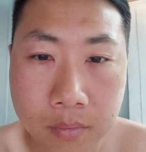 去眼袋手术