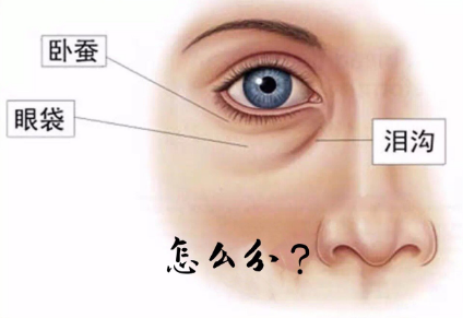 去眼袋手术