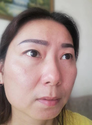 去眼袋手术