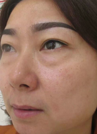 去眼袋手术