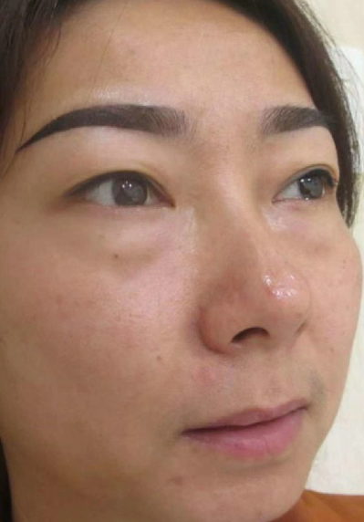 去眼袋手术