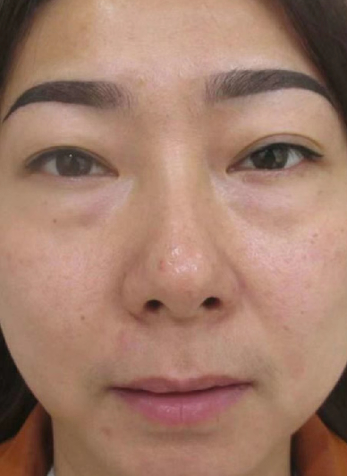 去眼袋手术