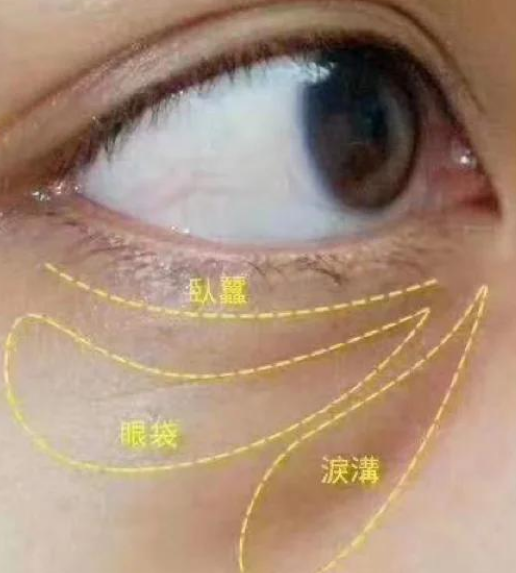 去眼袋手术