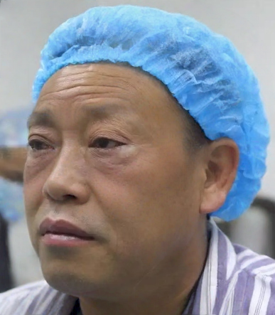 去眼袋手术