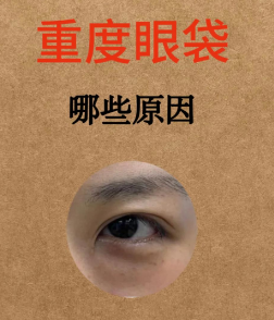 去眼袋手术