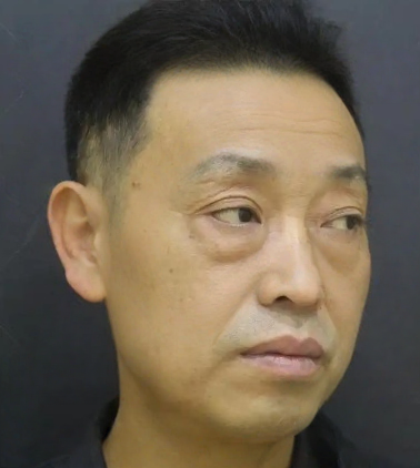 去眼袋手术