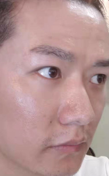 去眼袋手术