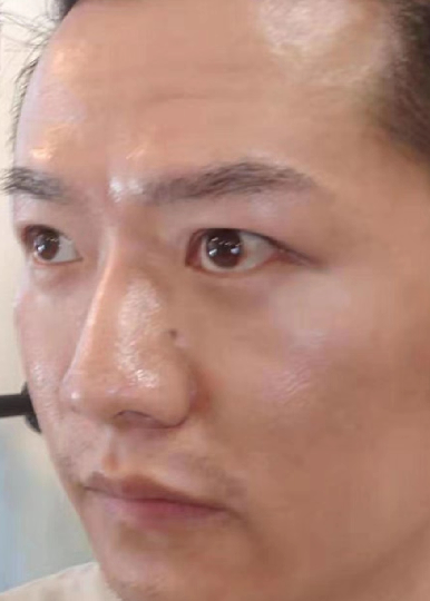 去眼袋手术