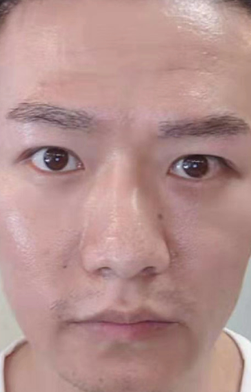 去眼袋手术