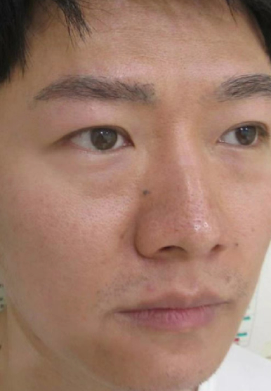 去眼袋手术