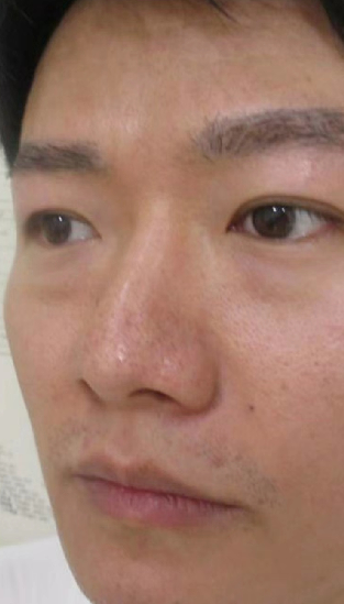 去眼袋手术
