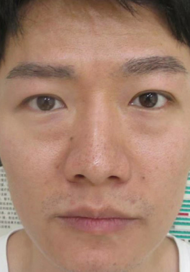 去眼袋手术
