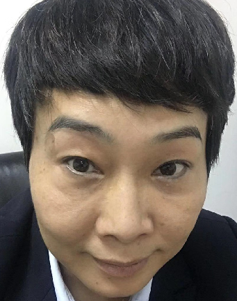去眼袋手术
