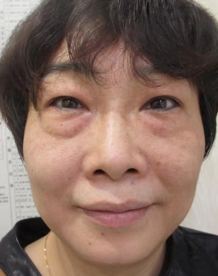 去眼袋手术