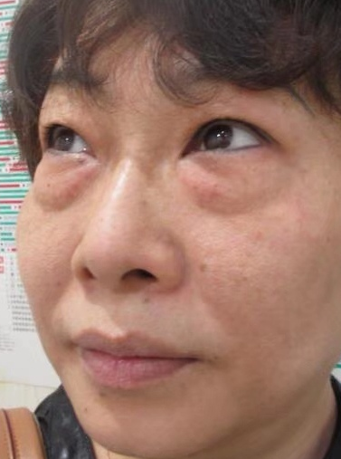 去眼袋手术