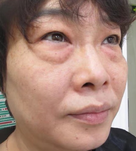 去眼袋手术