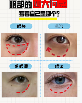 眼袋