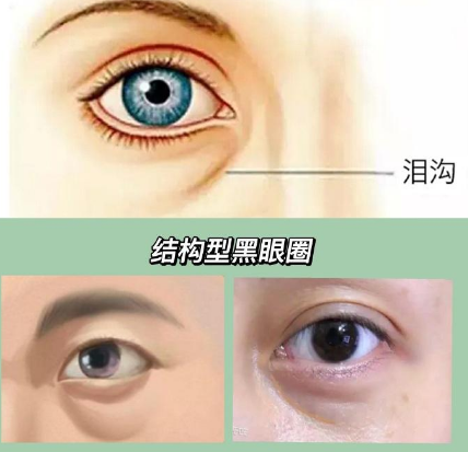 眼袋