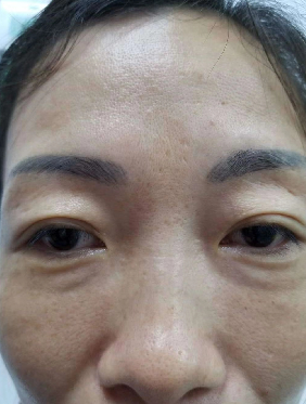 眼袋