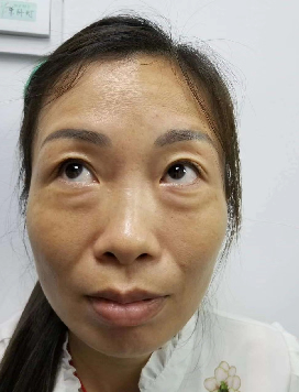 眼袋
