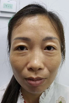 眼袋
