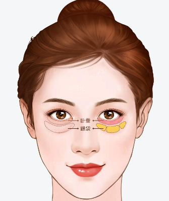 去眼袋手术