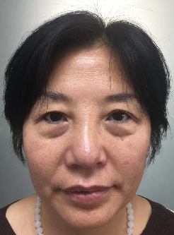 去眼袋手术