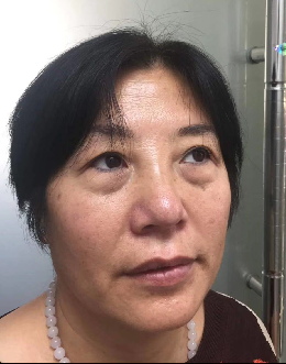 去眼袋手术