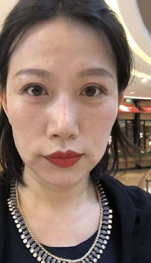 去眼袋手术