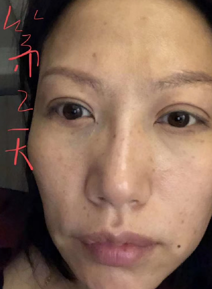 去眼袋手术