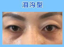 去眼袋手术