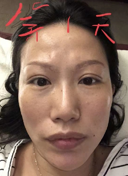 去眼袋手术
