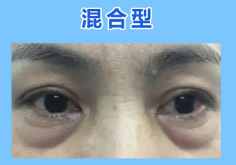 去眼袋手术