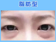 去眼袋手术