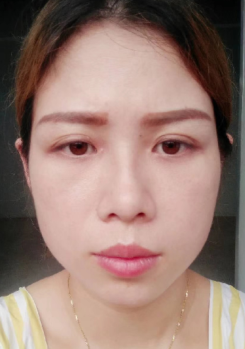 去眼袋手术