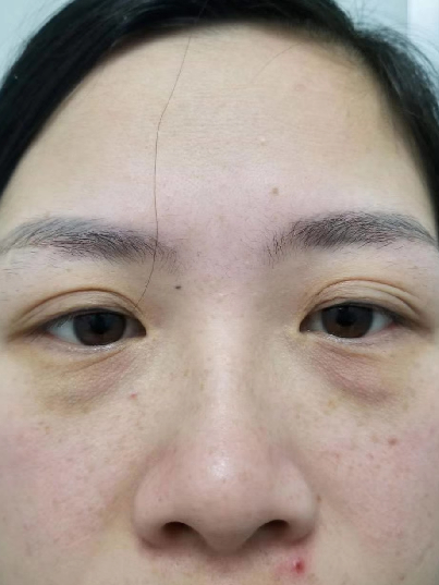 去眼袋手术
