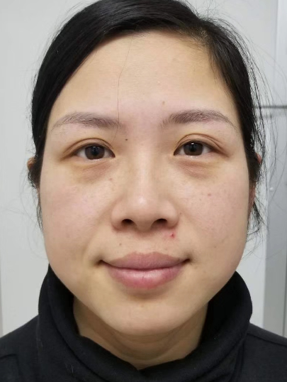 去眼袋手术