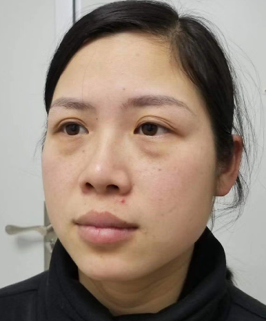 去眼袋手术