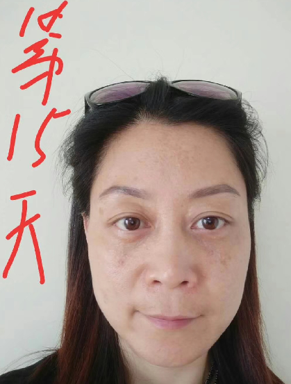 去眼袋手术