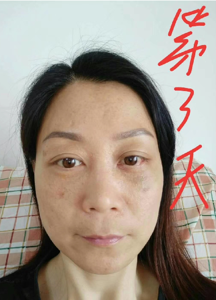 去眼袋手术