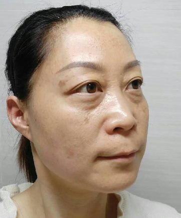 去眼袋手术